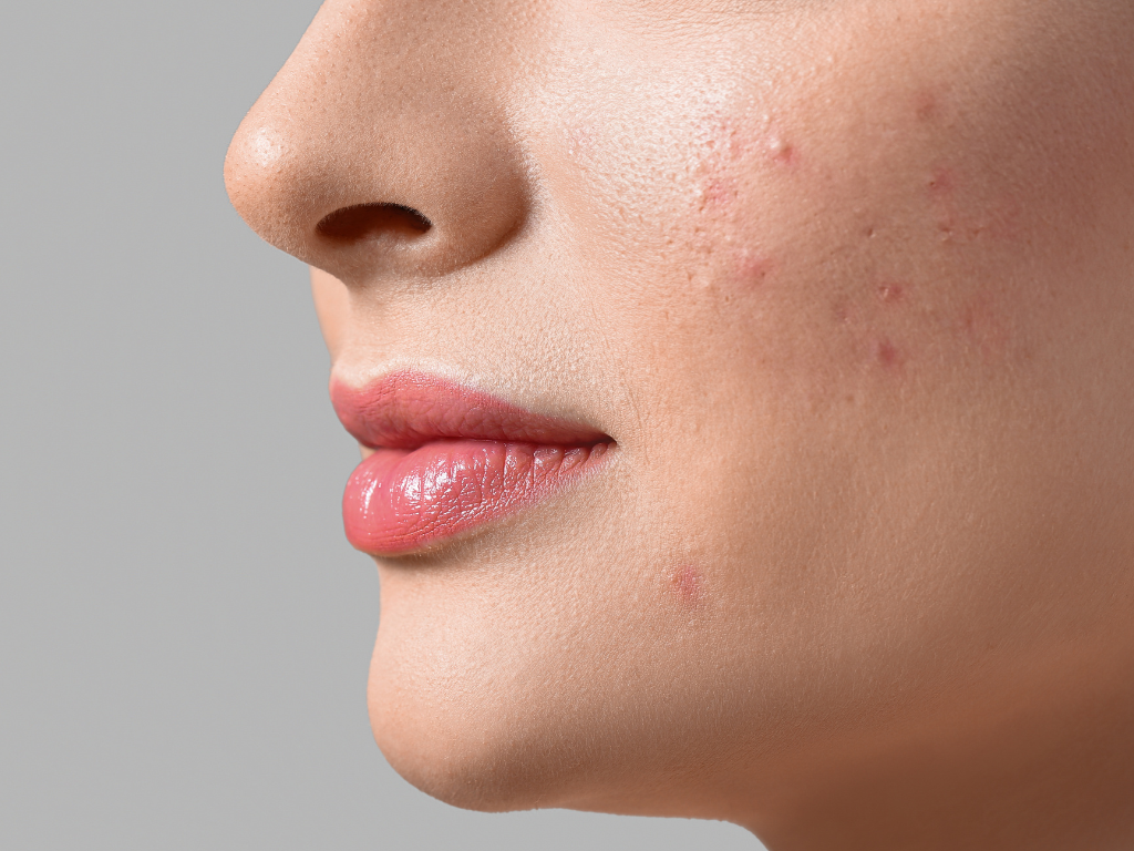 Blemishes Explained